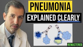 Pneumonia Explained Symptoms Diagnosis Labs Treatment [upl. by Amick]