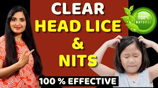 HOW TO REMOVE HEAD LICE amp NITS  Treat Lice Without Chemicals  Natural Remedy Headlice Haircare [upl. by Wulfe414]