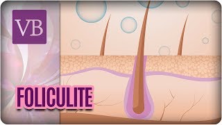 Foliculite  Receitas Caseiras  Você Bonita 210617 [upl. by Notgnilra]