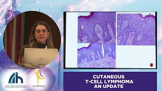 CHALLENGES IN DIAGNOSIS OF MYCOSIS FUNGOIDES  Dr Evangelia Papadavid [upl. by Deeas618]