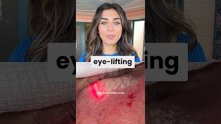 Laser Blepharoplasty Changing the Game LaserBlepharoplasty FastRecovery NaturalResults [upl. by Aneala466]