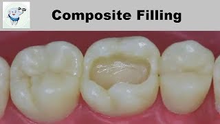 Composite Dental Filling Step by Step [upl. by Cob]