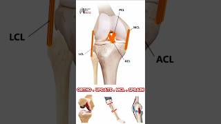 What is high tibial osteotomy   Dr Kunal  Orthopaedics [upl. by Samled]