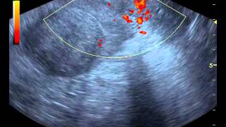 Myoma Uteri Ultrasound 13 [upl. by Rehctaht]