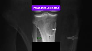 Intraosseous Lipoma [upl. by Dnomsaj26]