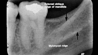 Dental Radiographic Anatomy [upl. by Arrio]