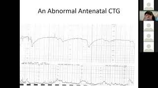 What is Cardiotocography   Gynaecology Lecture  MBBS Lecture MBBS [upl. by Attenborough]