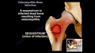 Osteomyelitis Bone Infection  Everything You Need To Know  Dr Nabil Ebraheim [upl. by Ray]