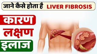 लिवर फाइब्रोसिस क्या होता है   लिवर फाइब्रोसिस होने के कारण लक्षण और इलाज  Liver Fibrosis [upl. by Shriver439]