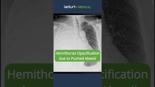 Hemithorax Opacification Pushed Alveoli Explained 🩺 ChestXray Radiology USMLE [upl. by Inamik]