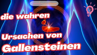 Gallensteine  das solltest Du wissen [upl. by Orpha]