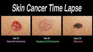 Skin Cancer Time Lapse Basal Cell Carcinoma Squamous Cell Carcinoma Melanoma [upl. by Nohsal]