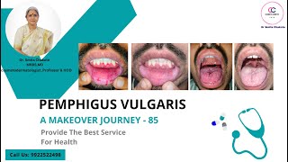 Pemphigus Vulgaris A Makeover Journey  85 पेम्फीगस वल्गैरिस एक गंभीर त्वचारोग  Dr Smita Chakote [upl. by Asek]