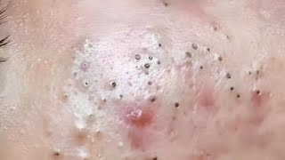 New Blackheads ​⁠BYoungSpa here [upl. by Edya]