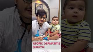 Atopic dermatitis drimranpatel baby shorts doctor [upl. by Eirollam789]