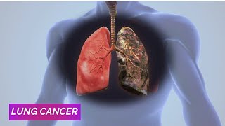 Formation of Lung Cancer  Lung Cancer Symptoms [upl. by Rori]