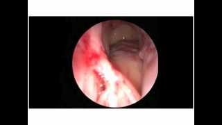 Balloon Sinus Dilation of the Frontal Sinus  Performed at the St Louis Sinus Center [upl. by Nirred418]