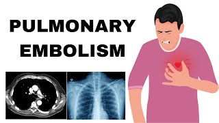 Pulmonary Embolism Pathophysiology Etiology Symptoms Diagnosis amp Treatment [upl. by Neoma]