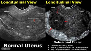 Uterus Ultrasound Normal Vs Subserosal Fibroid Images  Uterine Leiomyomas Cases  Pelvic USG Cases [upl. by Filia]