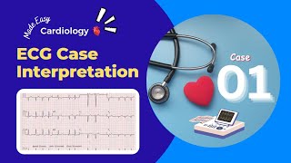 Abnormality in ECG Graph  Discussion about ECG Cases  ECG Cases for Students [upl. by Corwun]