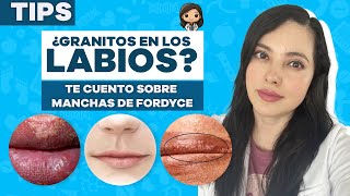 ¿GRANITOS BLANCOAMARILLENTOS EN LABIOS 🧐Te cuento que son 👩🏻‍⚕️ [upl. by Fry]