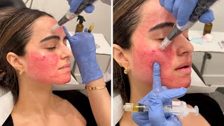 Getting the Vampire Facial 💉 You gotta see these results [upl. by Cherian179]