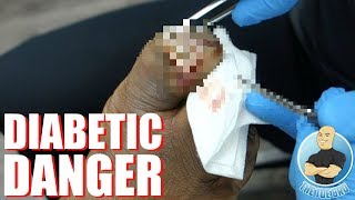 HUGE DIABETIC BLISTER FOLLOWUP [upl. by Kristien]