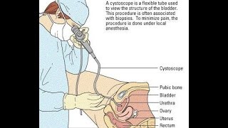 Video Cystoscopy Actual Procedure ENG SUB [upl. by Hollington]