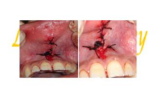 Preprosthetic sugery Soft tissues procedures [upl. by Ocirderf896]