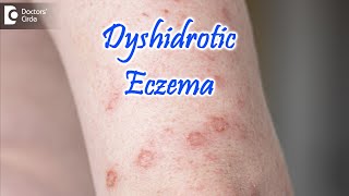 Dyshidrotic Eczema  POMPHOLYX   Causes Symptoms amp Treatment  Dr Nischal K  Doctors Circle [upl. by Ahseiuqal452]