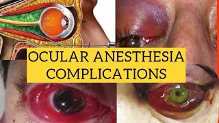 Complications of ocular anesthesia  Diagnosis and management [upl. by Holli]