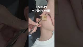 리팟 레이저 다발성 흑자 세종리팟 세종시리팟 reepot lentigo multiplelentigo 청주리팟 공주리팟 대전리팟 오창리팟 오송리팟 부여리팟 [upl. by Ona]