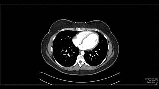 Abdominal Anatomy on Computed Tomography [upl. by Nitsirk592]