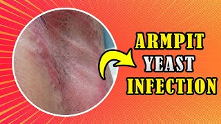 How to treat Armpit yeast infection Candida at home [upl. by Ahtiuqal]