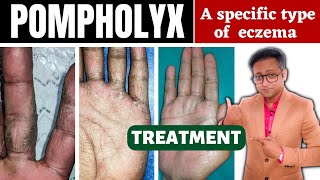 Dyshidrotic eczema  Pompholyx  Treatment  Hindi [upl. by Ahsatsana]