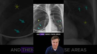 Emphysema on chest xray [upl. by Zales]