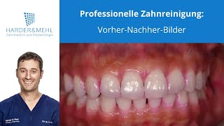 Professionelle Zahnreinigung VorherNachherBilder [upl. by Naret453]