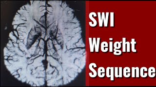 Susceptibility Weight IMaging SWI Sequence [upl. by Esma]