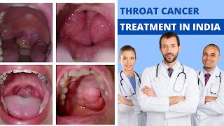 Throat Cancer Treatment in India Throat Cancer Treatment Cost in India [upl. by Kory]