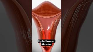 Using heated fluid to stop heavy periods 3D Animation [upl. by Ennirak]