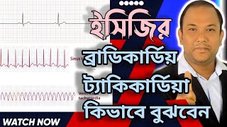 bradycardiatachycardia banglasupraventicular tachycardia ecgSVT [upl. by Sanjay]