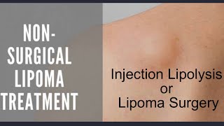 INJECTION LIPOLYSIS Vs LIPOMA REMOVAL SURGERY EXPERIENCE  RISKS amp BENEFITS DR ASHISH BHANOT [upl. by Wauters416]