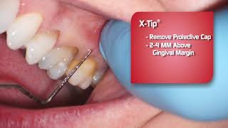 XTIP Intraosseous Anesthetic Delivery System [upl. by Auqinat]