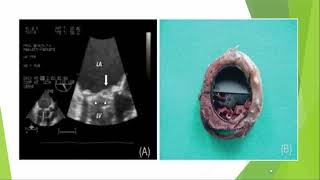 Acute prosthetic valve thrombosis Prof Mohamed Helmy [upl. by Uhsoj]