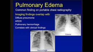 edema atelectasis and consoldiation [upl. by Bucky895]