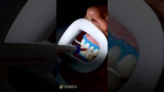 Teeth Whitening smilemakeover teethwhitening teeth nowaesthetic [upl. by Kalinda]