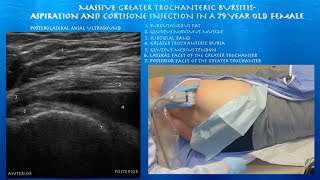 Ultrasound Guided Massive Greater Trochanteric Bursitis Aspiration and Injection by probeultrasound [upl. by Weinstein747]