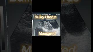 Bulky Uterus  Heterogenous Variable Texture of Uterus  Ovarian Cysts  Adnexa Cyst on Ultrasound [upl. by Jara569]