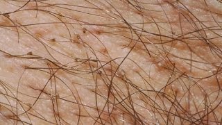 Home Remedies for Body Lice Infestation [upl. by Latin]