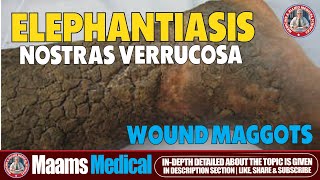 Elephantiasis Nostras Verrucosa and Wound Maggots  Rare Skin Disease [upl. by Nnaeirrac]